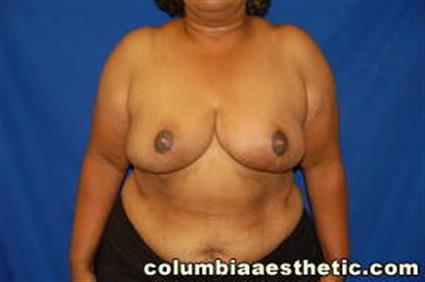 Breast Reduction Patient Photo - Case 17 - after view-0