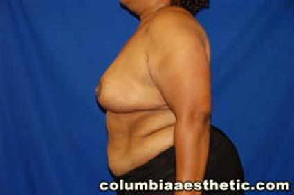 Breast Reduction Patient Photo - Case 17 - after view-1