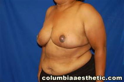 Breast Reduction Patient Photo - Case 17 - after view-2