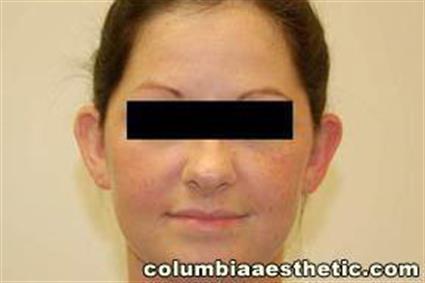 Ear Surgery (Otoplasty) Patient Photo - Case 18 - before view-