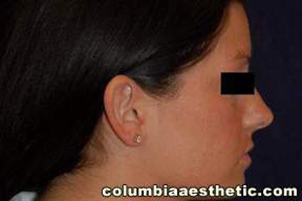 Ear Surgery (Otoplasty) Patient Photo - Case 18 - before view-2