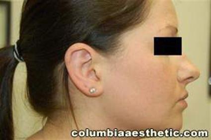 Ear Surgery (Otoplasty) Patient Photo - Case 18 - after view-2