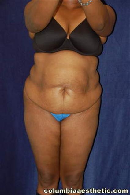 Abdominoplasty (Tummy Tuck) Patient Photo - Case 2 - before view-