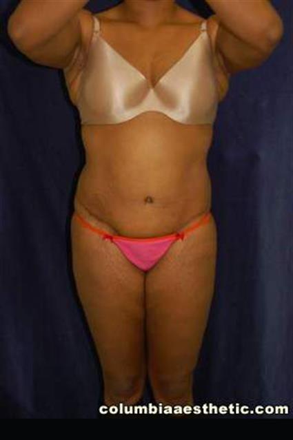 Abdominoplasty (Tummy Tuck) Patient Photo - Case 2 - after view
