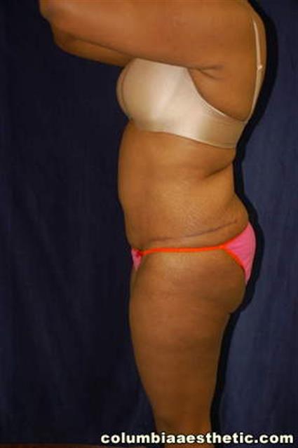 Abdominoplasty (Tummy Tuck) Patient Photo - Case 2 - after view-2