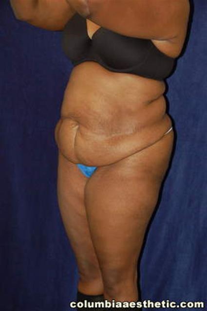 Abdominoplasty (Tummy Tuck) Patient Photo - Case 2 - before view-1