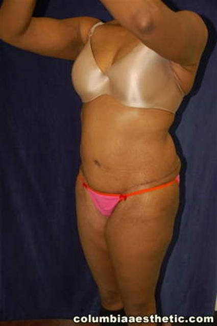 Abdominoplasty (Tummy Tuck) Patient Photo - Case 2 - after view-1
