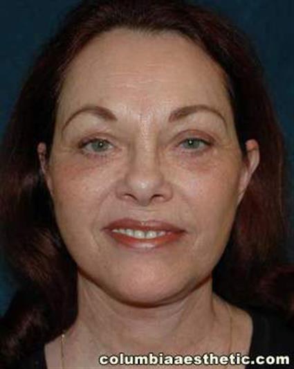 Facelift Surgery - Case 20 - After