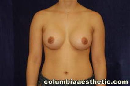 Breast Augmentation - Case 21 - After
