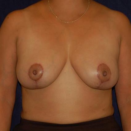 Breast Reduction Patient Photo - Case 23 - after view