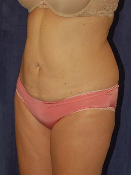 Liposuction Patient Photo - Case 28 - after view-0