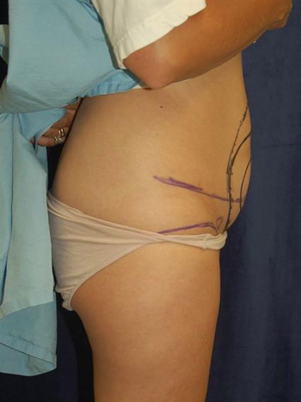 Liposuction Patient Photo - Case 28 - before view-1
