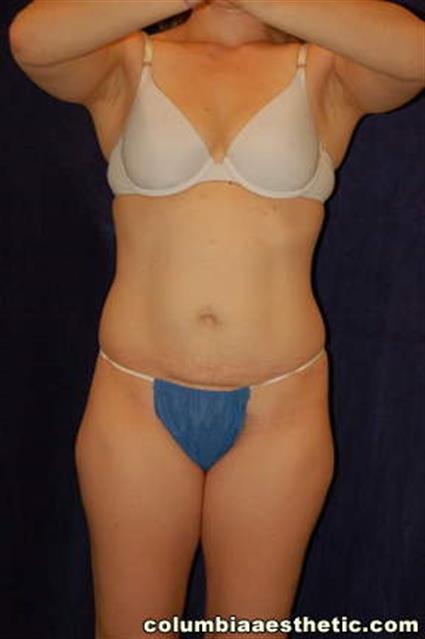 Abdominoplasty (Tummy Tuck) Patient Photo - Case 3 - before view-1