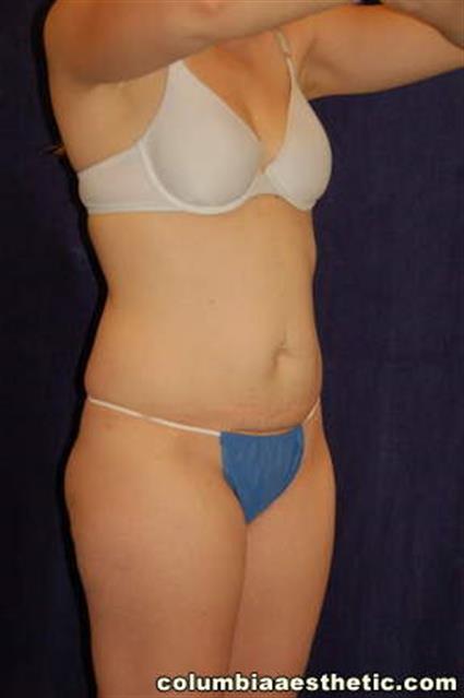 Abdominoplasty Patient Photo - Case 3 - before view-2