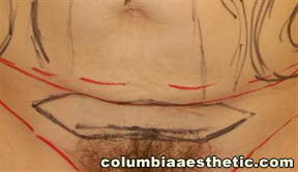Abdominoplasty (Tummy Tuck) Patient Photo - Case 3 - before view-3