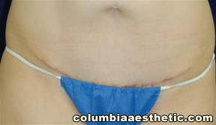 Abdominoplasty (Tummy Tuck) Patient Photo - Case 3 - after view-3