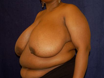 Breast Reduction Patient Photo - Case 30 - before view-2