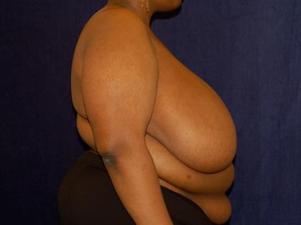 Breast Reduction Patient Photo - Case 30 - before view-3