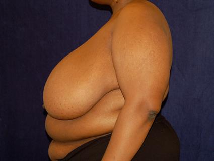 Breast Reduction Patient Photo - Case 30 - before view-4