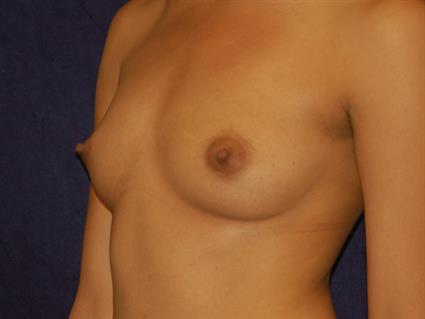 Breast Augmentation Patient Photo - Case 33 - before view-1