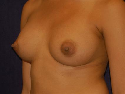 Breast Augmentation Patient Photo - Case 33 - after view-1