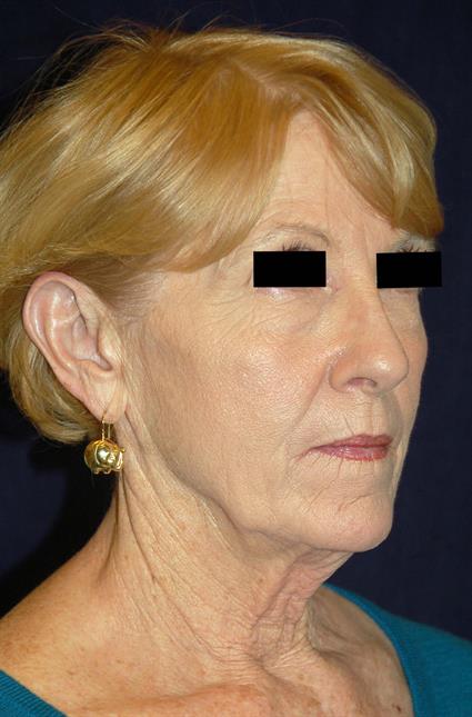 Eyelid Surgery - Case 34 - Before