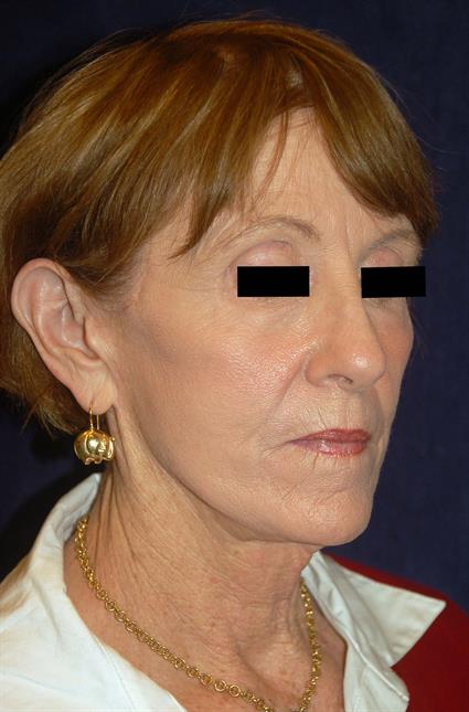 Eyelid Surgery Patient Photo - Case 34 - after view-0