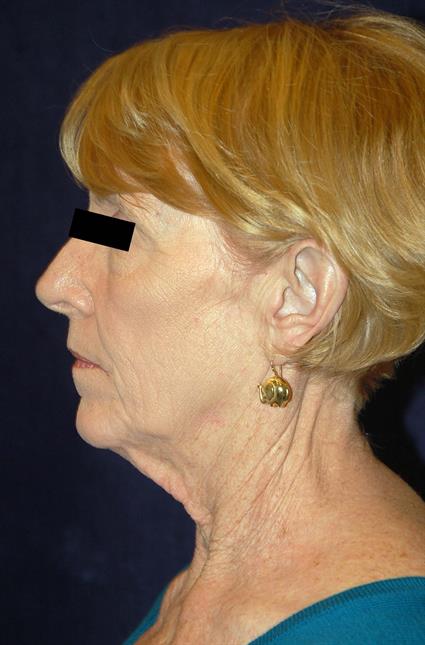 Eyelid Surgery Patient Photo - Case 34 - before view-1