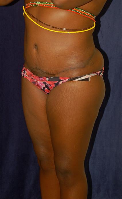 Abdominoplasty (Tummy Tuck) Patient Photo - Case 37 - after view-0
