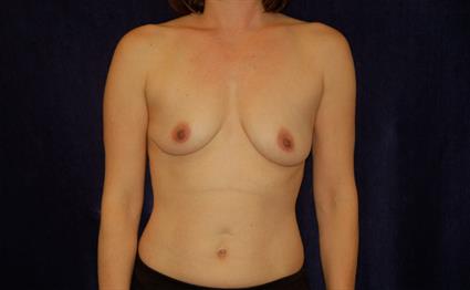 Breast Augmentation Patient Photo - Case 39 - before view-