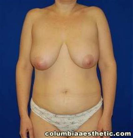 Abdominoplasty (Tummy Tuck) Patient Photo - Case 4 - before view-0