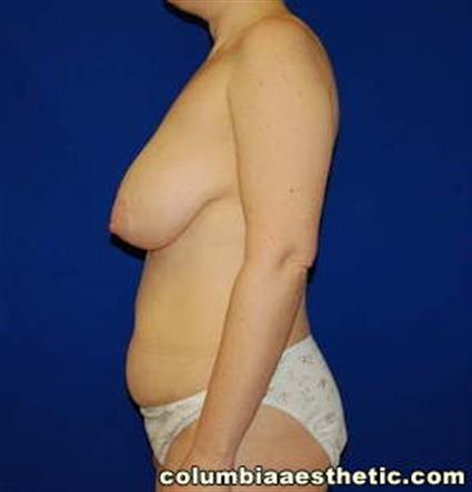 Abdominoplasty (Tummy Tuck) Patient Photo - Case 4 - before view-1