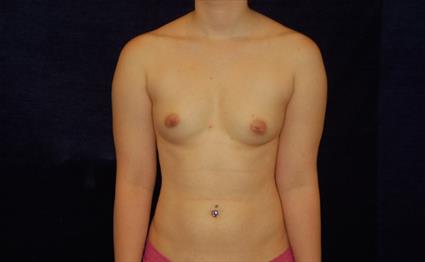 Breast Augmentation - Case 41 - Before