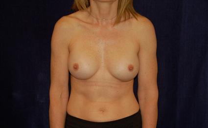 Breast Augmentation Patient Photo - Case 45 - after view-0