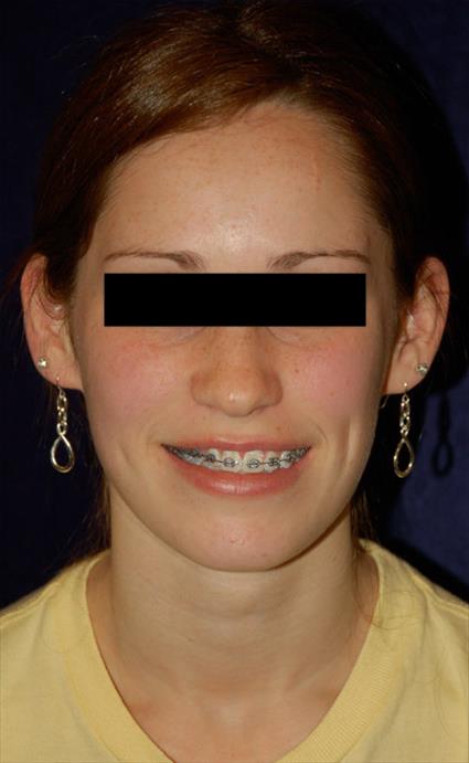 Ear Surgery (Otoplasty) - Case 46 - Before