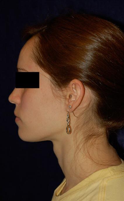 Ear Surgery (Otoplasty) Patient Photo - Case 46 - before view-1