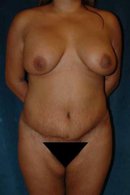 Abdominoplasty (Tummy Tuck) Patient Photo - Case 5 - after view