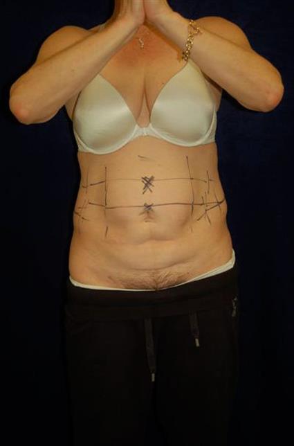 CoolSculpting - Case 50 - Before