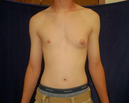 Male Breast Reduction (Gynecomastia) Patient Photo - Case 52 - before view-