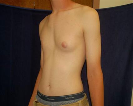 Male Breast Reduction (Gynecomastia) Patient Photo - Case 52 - before view-1