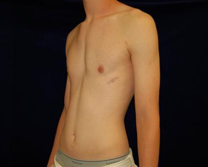 Male Breast Reduction (Gynecomastia) Patient Photo - Case 52 - after view-1