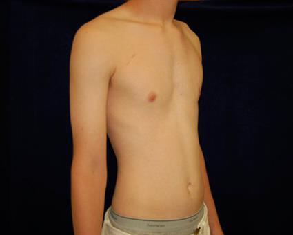 Male Breast Reduction (Gynecomastia) Patient Photo - Case 52 - after view-2