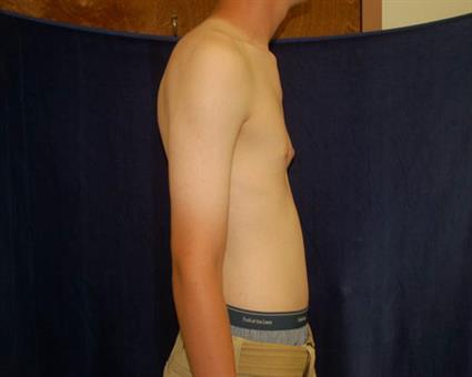 Male Breast Reduction (Gynecomastia) Patient Photo - Case 52 - before view-4