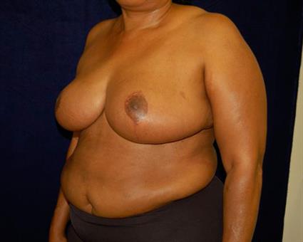 Breast Reduction Patient Photo - Case 53 - after view-1