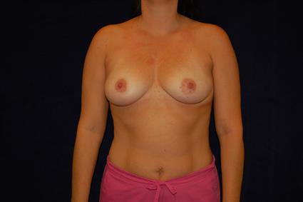 Breast Augmentation Patient Photo - Case 57 - before view-0