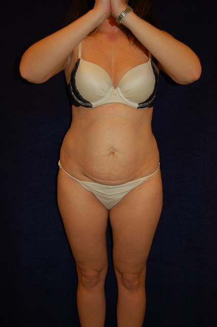 Abdominoplasty (Tummy Tuck) Patient Photo - Case 58 - before view-