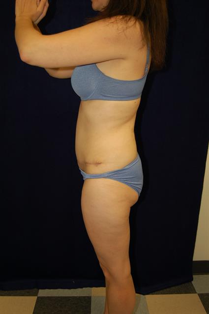 Abdominoplasty (Tummy Tuck) Patient Photo - Case 58 - after view-1