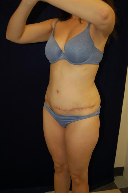 Abdominoplasty (Tummy Tuck) Patient Photo - Case 58 - after view-2