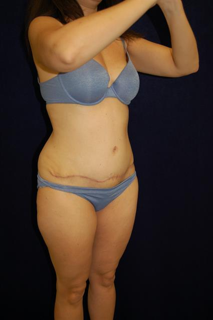 Abdominoplasty (Tummy Tuck) Patient Photo - Case 58 - after view-3
