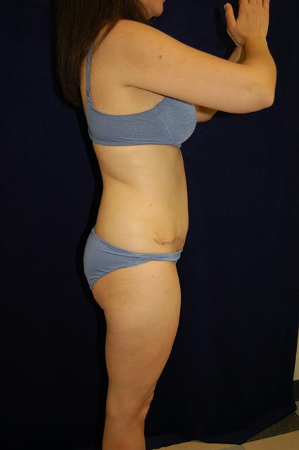 Abdominoplasty (Tummy Tuck) Patient Photo - Case 58 - after view-4